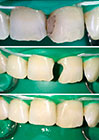Реставрация передних зубов цена