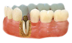 Культевые вкладки на зубах