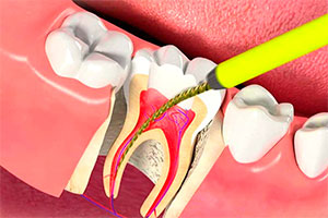 Лечение пульпита у взрослых в стоматологии Для Семьи в Краснодаре