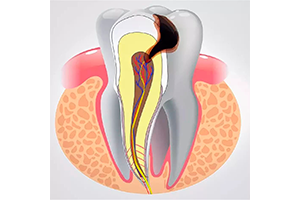 Лечение острого пульпита у взрослых в стоматологии Для Семьи в Краснодаре
