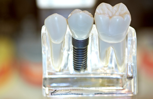 Имплант на зуб цена